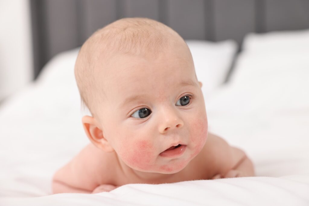 «Не каждая сыпь — аллергия»: честный разговор о детской коже с Натальей Картледж | London Cult.